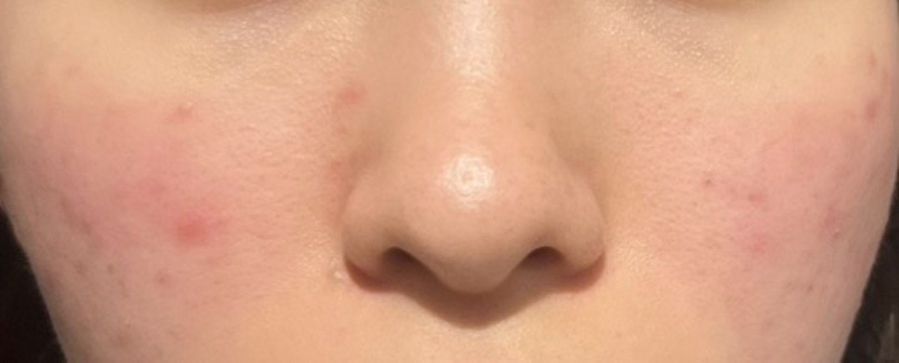 before photo: ハイドラフェイシャル