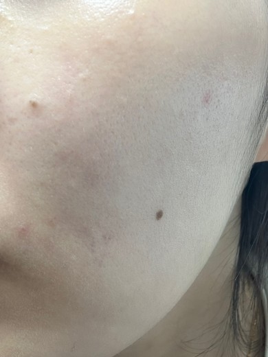 before photo: 여드름압출