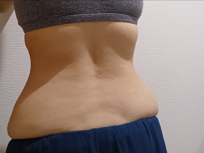 before photo: 高周波脂肪溶解(腹部)