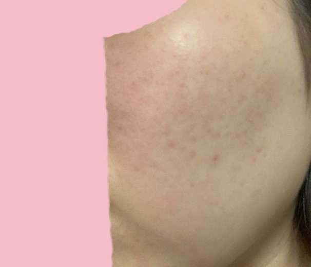 before photo: IPL(光/フォト治療), ルメッカ