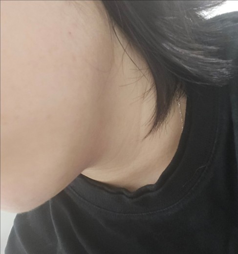 after photo: 사각턱보톡스, 튠라이너