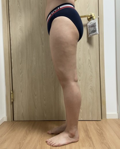 after photo: 허벅지지방흡입