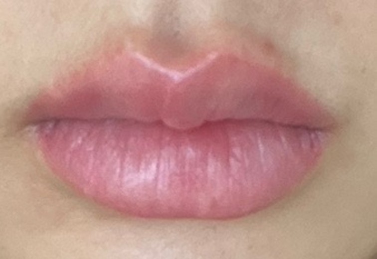 after photo: 입술필러