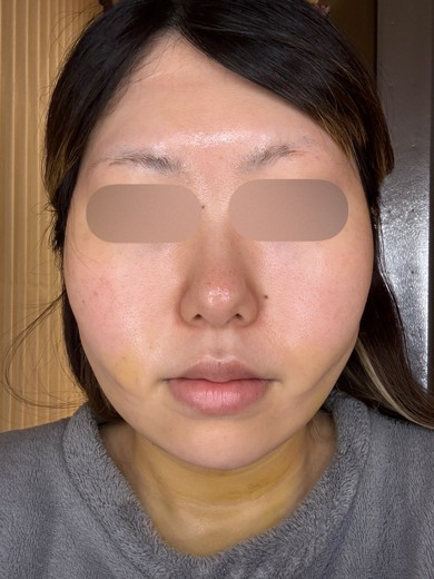 after photo: 糸リフト, 脂肪吸引(顎下), 脂肪吸引(顔), 脂肪吸引(頬)