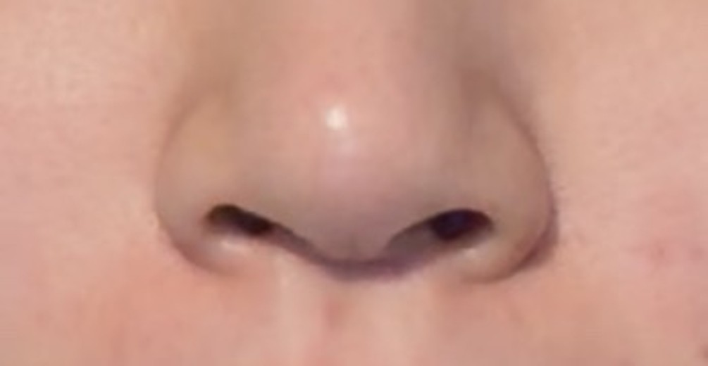 before photo: 콧볼축소