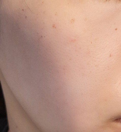 after photo: IPL(光/フォト治療), 診断・検査