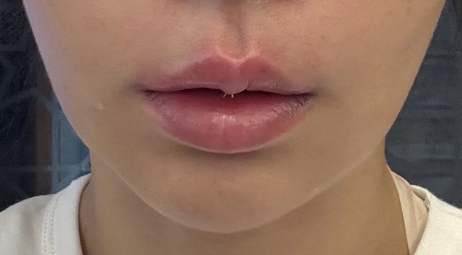 after photo: 입술필러