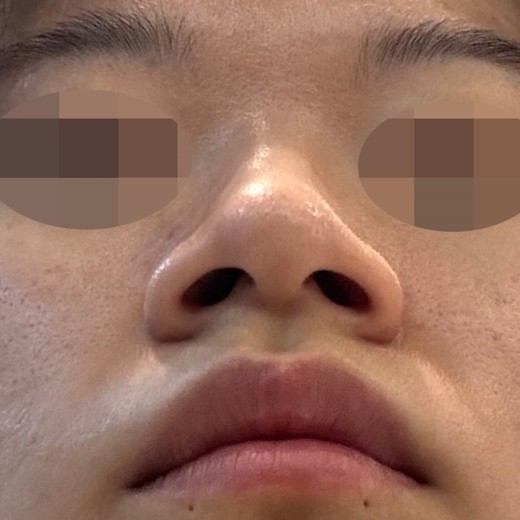 before photo: 콧볼축소