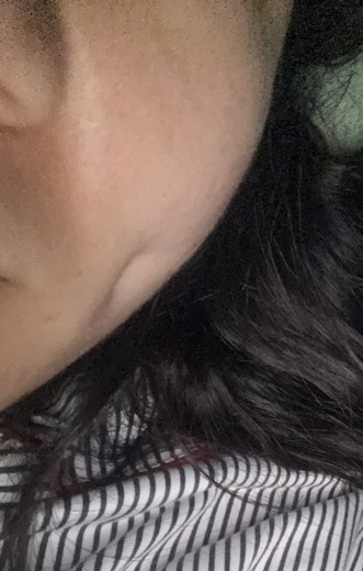 after photo: 보조개성형