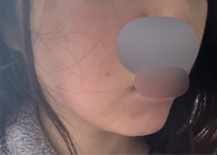 after photo: 脂肪溶解注射(顔)