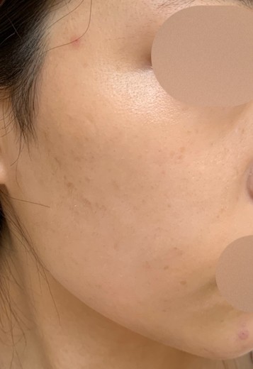 before photo: IPL(光/フォト治療), ルメッカ