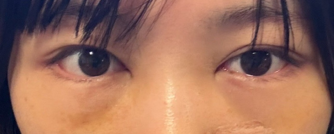 after photo: 目の下脂肪再配置(ハムラ・裏ハムラ法)