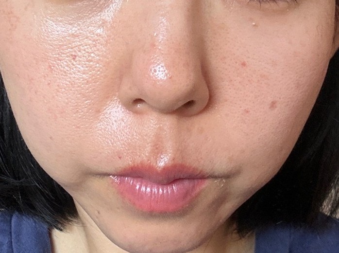 after photo: スキンボトックス, ジュベルック(Juvelook)