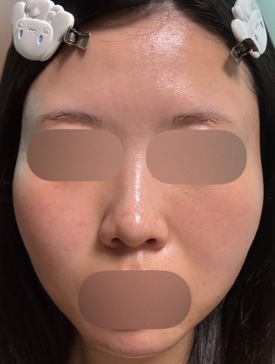 after photo: ジュベルック(Juvelook)
