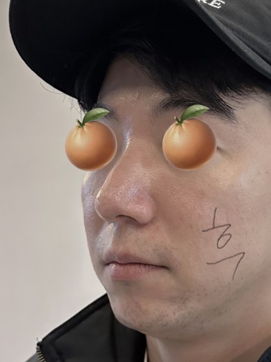 after photo: 콧대(보형물), 코끝(자가연골), 비후성비염수술