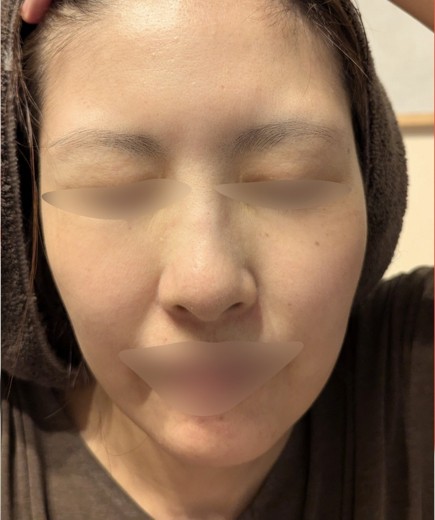 after photo: 水光注射