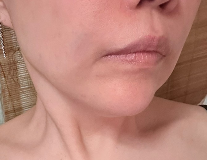 after photo: 脂肪溶解注射(顔)