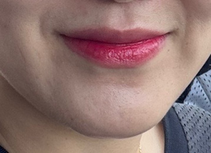 after photo: 인모드리프팅