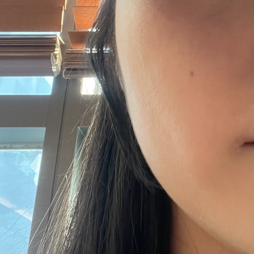 before photo: 사각턱보톡스