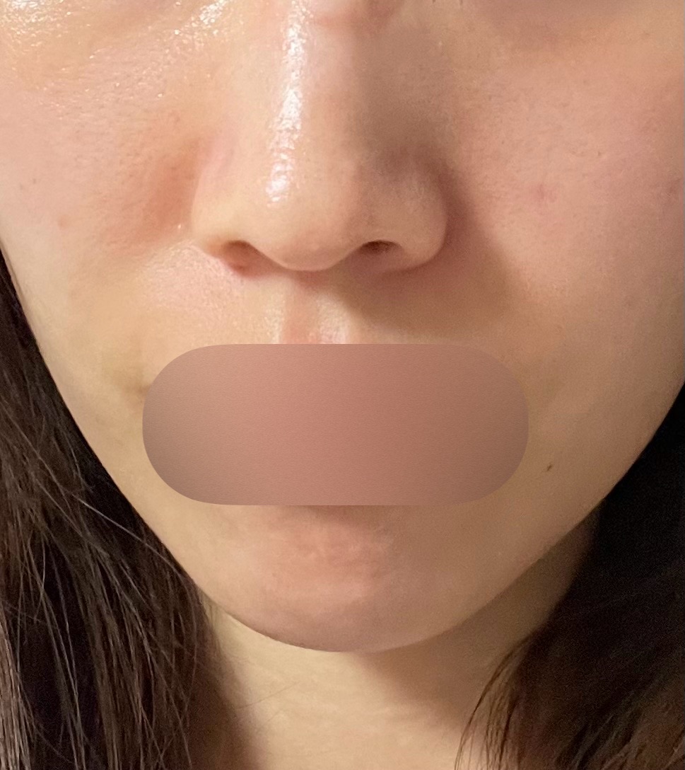 ジェネシス＋エレクトロポレーション【再来OK】 | ライズワン