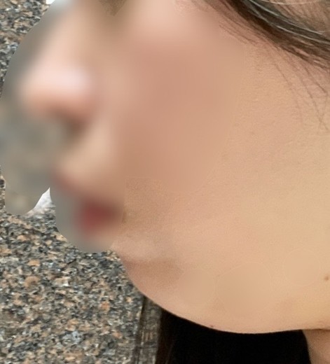 after photo: 脂肪溶解注射(顔)