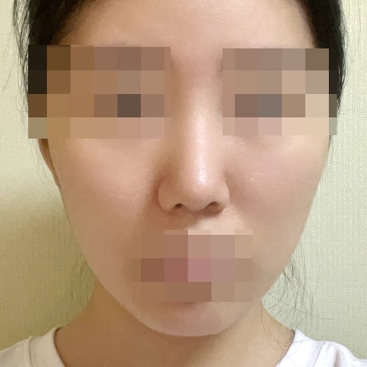 after photo: 코끝(자가연골)