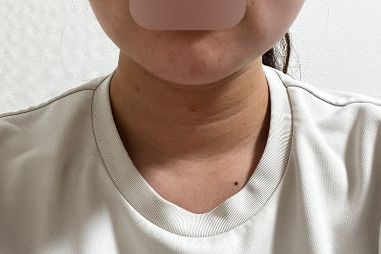 after photo: 脂肪吸引注射