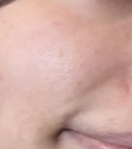 before photo: IPL(光/フォト治療)