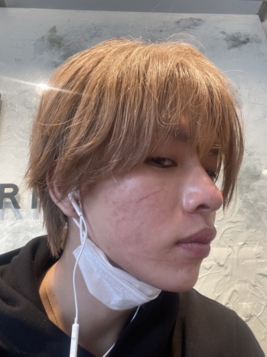 after photo: ダーマペン