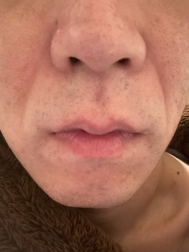 after photo: 糸リフト, 診断・検査