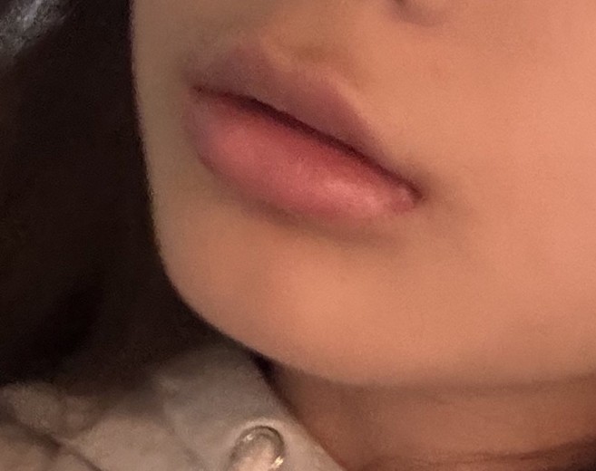 after photo: 입술필러