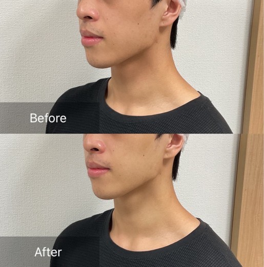 after photo: チタニウムリフト