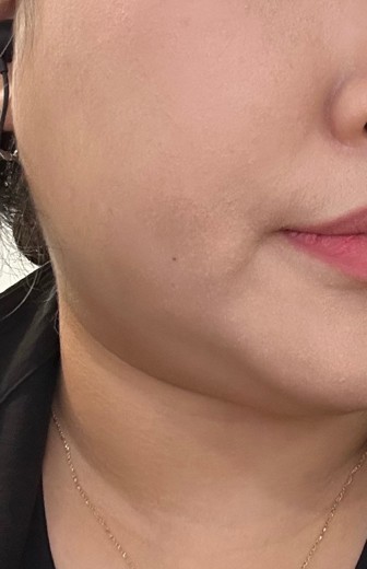 before photo: 윤곽주사