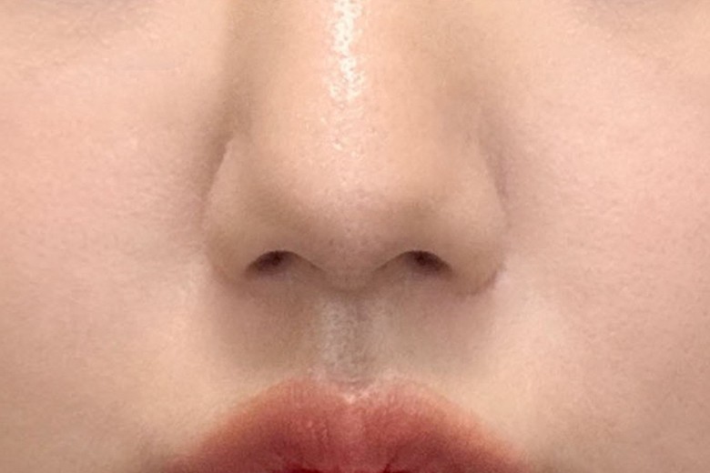 after photo: 피코토닝