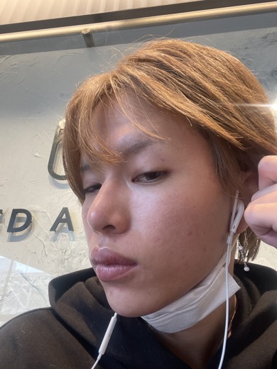 after photo: ダーマペン