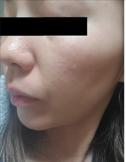 after photo: エレクトロポレーション