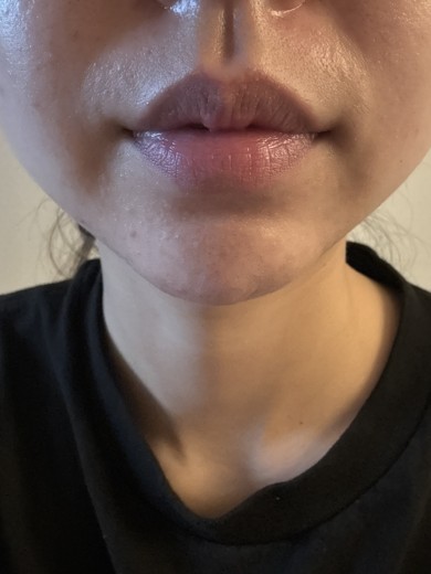 before photo: 얼굴지방분해주사