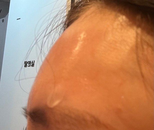 after photo: 이마필러, 관자놀이필러