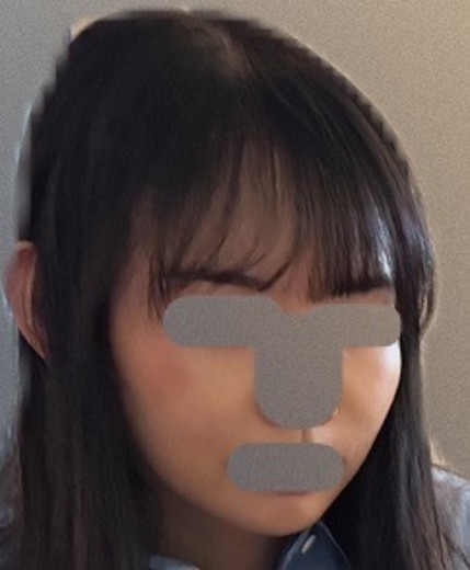 after photo: サーモン注射