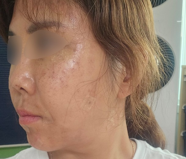 after photo: 점제거시술, V레이저