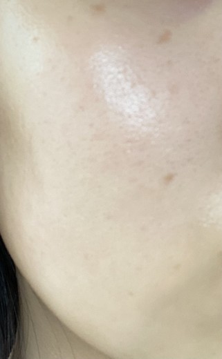 after photo: イオン導入