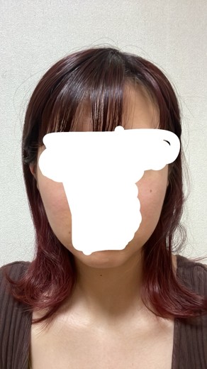 after photo: 脂肪溶解注射(顔)
