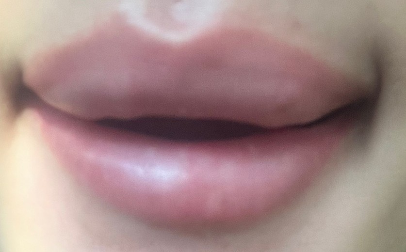 after photo: 입술필러