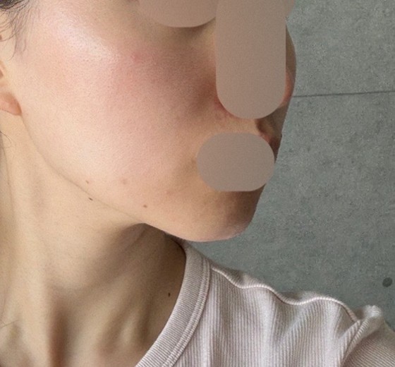 after photo: チタニウムリフト