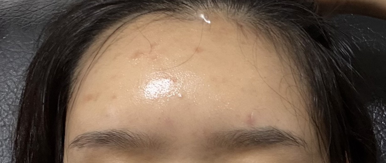 after photo: 이마필러, 관자놀이필러