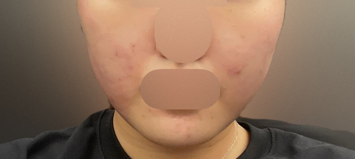 after photo: 인모드리프팅