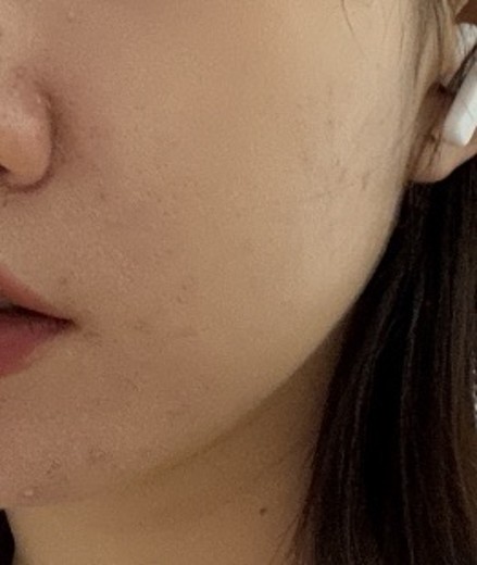 after photo: 피코토닝