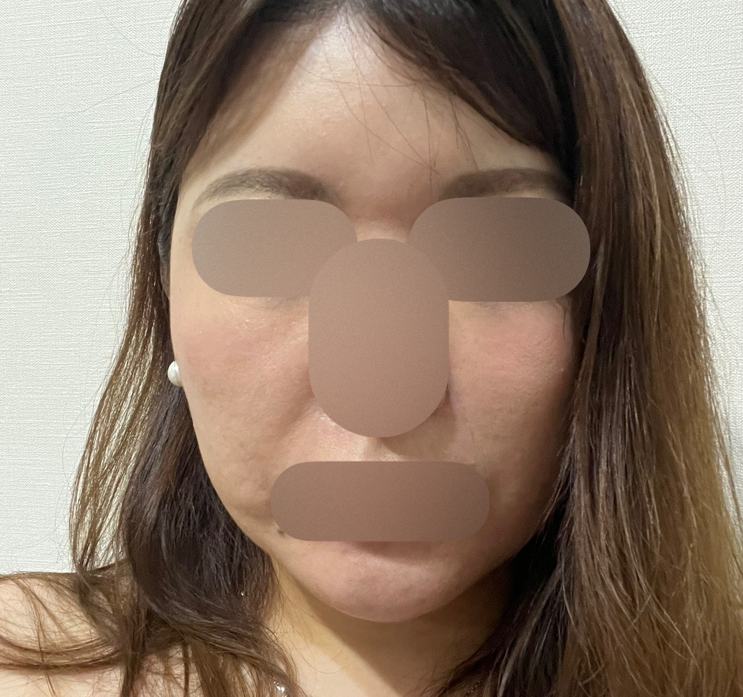 痛みを最小限に抑えたエラビエリトゥオ, リジュラン フルフェイス