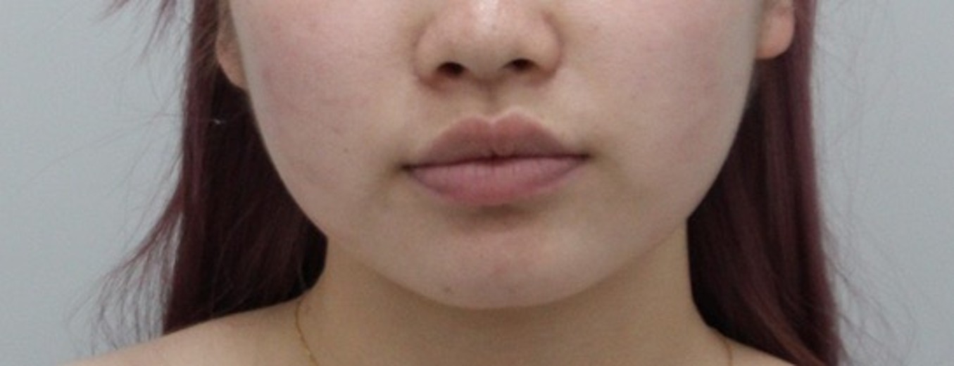 before photo: ふくらはぎボトックス, エラボトックス