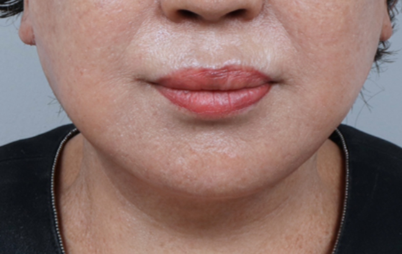 after photo: 실리프팅